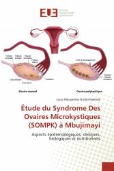 Étude du Syndrome Des Ovaires Microkystiques (SOMPK) à Mbujimayi