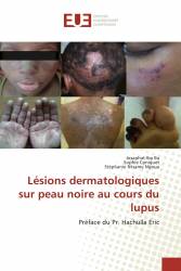 Lésions dermatologiques sur peau noire au cours du lupus