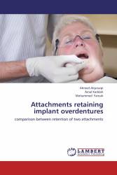 Attachments retaining implant overdentures