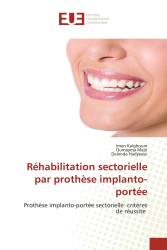 Réhabilitation sectorielle par prothèse implanto-portée
