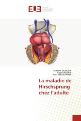 La maladie de Hirschsprung chez l’adulte