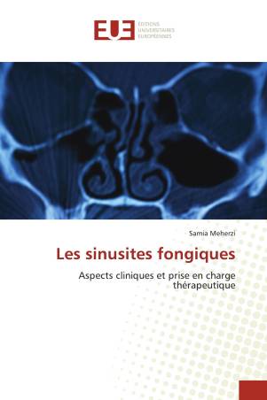 Les sinusites fongiques